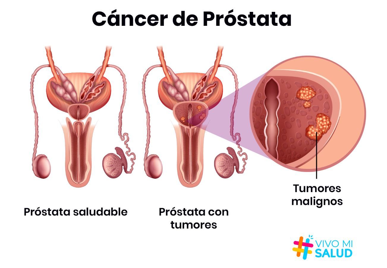 Cáncer de próstata: Detección temprana y tratamientos avanzados